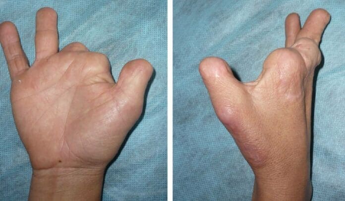 Desnudo y con dedos mutilados, abandonan a hombre en malecón de Cozumel