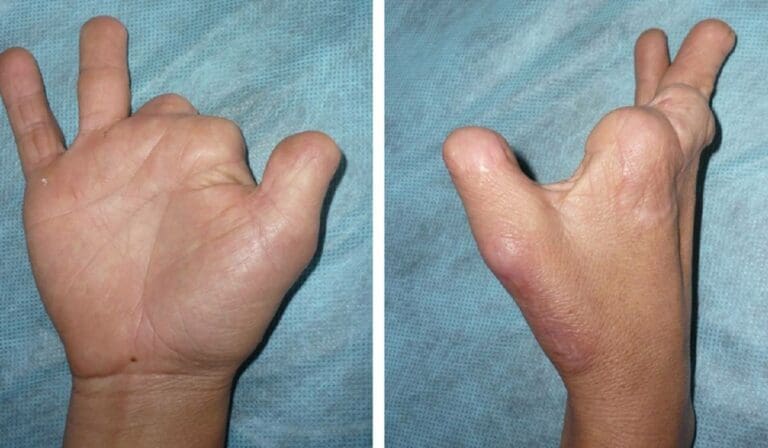 Desnudo y con dedos mutilados, abandonan a hombre en malecón de Cozumel