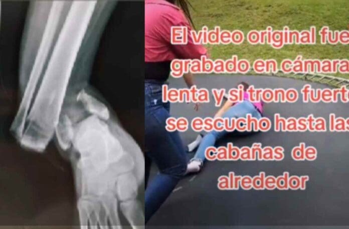 VIDEO: Mujer se rompe el pie por saltar en trampolín y fractura se vuelve viral