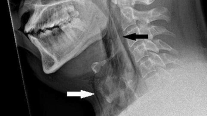 Hombre se le desgarra la tráquea por evitar estornudo