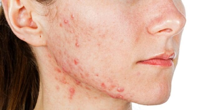 Científicos aseguran estar muy cerca de crear una vacuna para combatir el acné