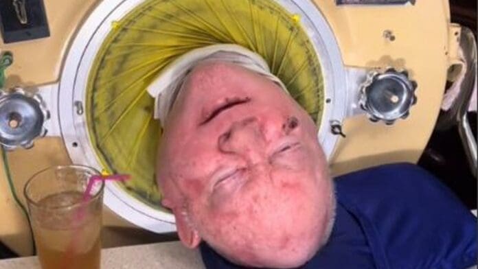 Muere Paul Alexander, hombre que vivió 70 años en un pulmón de acero