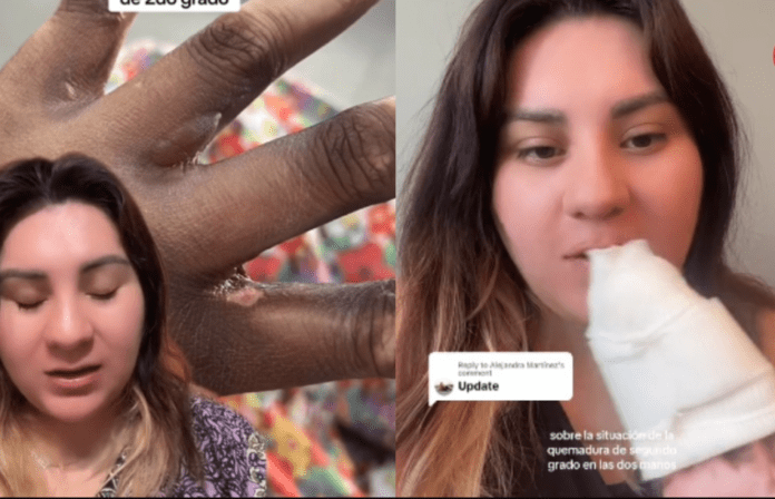 VIDEO: Mujer que afirma haber sido funcionaria de casilla acusa que sufrió quemadura por tinta indeleble