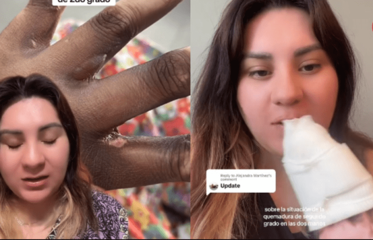 VIDEO: Mujer que afirma haber sido funcionaria de casilla acusa que sufrió quemadura por tinta indeleble