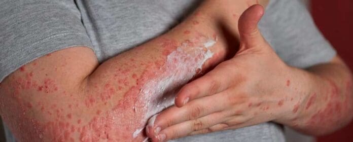 Detectan una nueva ETS en Estados Unidos causada por hongos