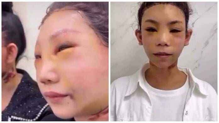 Deforman rostros de mujeres con estiramientos faciales para quitar arrugas en China