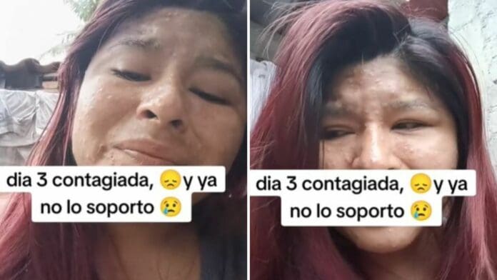 VIDEO: Mujer relata su sufrimiento tras contagiarse de viruela del mono