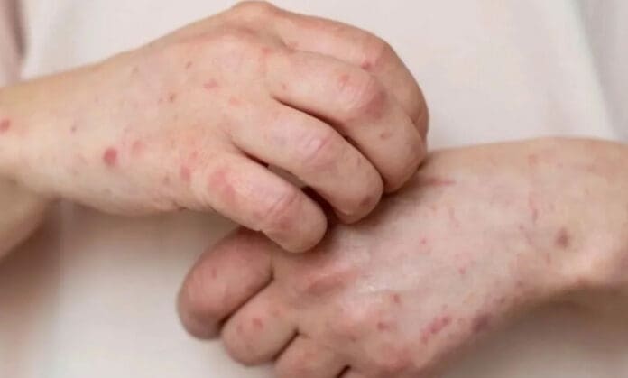 Paciente con viruela del mono escapa del hospital en transporte público sin hacer cuarentena en Nayarit