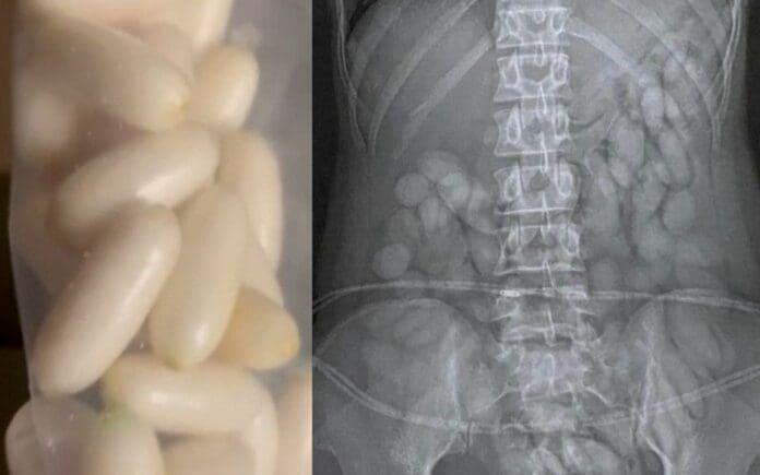 Detienen a mujer con 63 'balas' de cocaína en su organismo en Sudáfrica