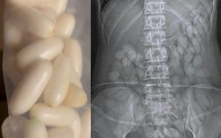 Video: Detienen a mujer con 63 ‘balas’ de cocaína en su organismo en Sudáfrica