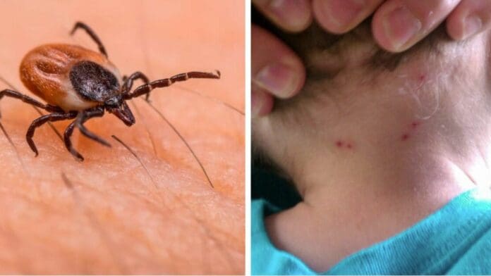 Niño de cinco años pierde la vida tras picadura de garrapata en Saltillo, Coahuila