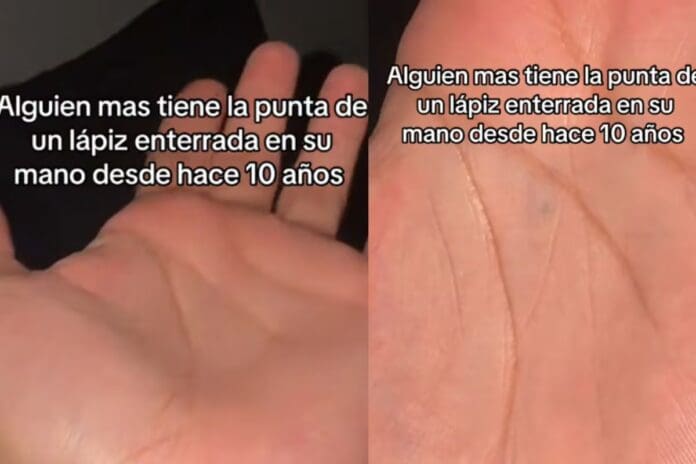 VIDEO: Hombre se hace viral por mostrar la punta de un lápiz enterrada en su mano desde que tenía 10 años