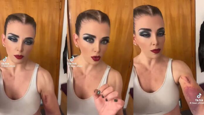 Video: Cantante Lisset cae a una coladera en CDMX y sufre graves lesiones en sus extremidades