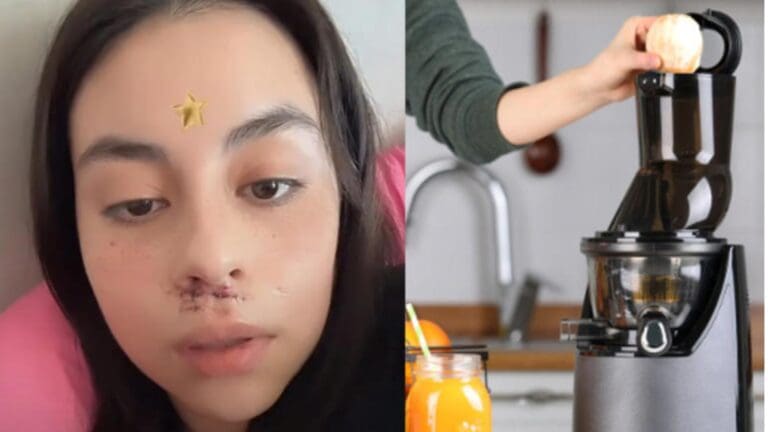 Joven sufre lesión en la cara tras fallarle el extractor de jugos que compró en Amazon