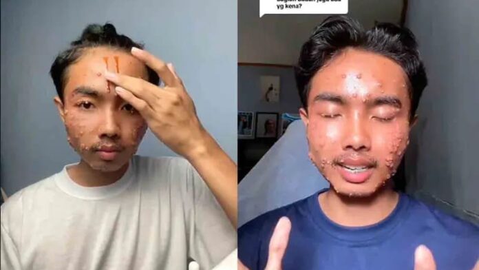 Video: Joven contrae extraña enfermedad en la piel por usar ropa de segunda mano