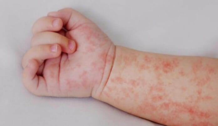 Confirman las autoridades el primer caso de sarampión en Quintana Roo desde 2019, es una menor de Bacalar.