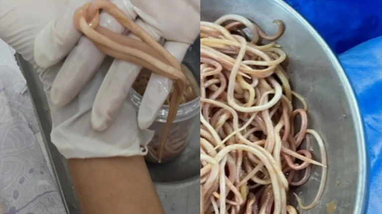 Doctora extrae 142 lombrices a un niño en Chiapas