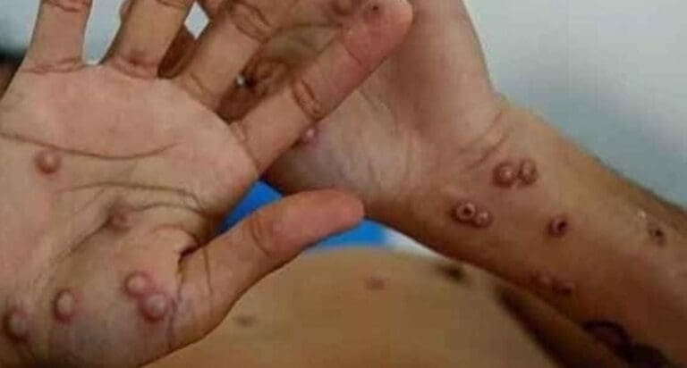 Confirman caso positivo de viruela símica en Quintana Roo; es paciente que fue de Playa del Carmen a Cancún.