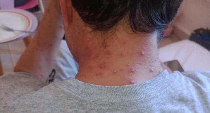 Descartan autoridades de Playa del Carmen supuesto caso de viruela símica que circula en redes sociales. No es positivo.