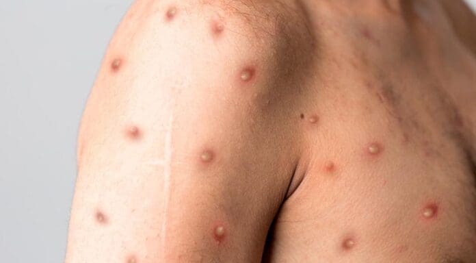 Fallece un paciente con viruela símica en Quintana Roo; era el caso enviado de Playa del Carmen a Cancún hace unos días.