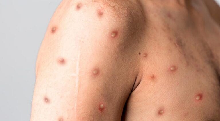 Fallece un paciente con viruela símica en Quintana Roo; era el caso enviado de Playa del Carmen a Cancún hace unos días.