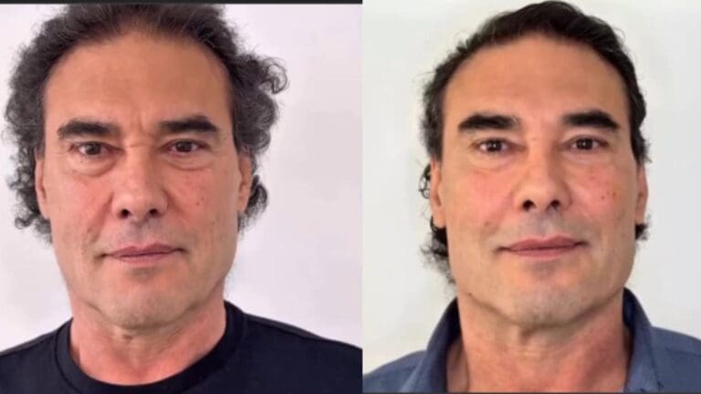Actor Eduardo Yáñez se somete a cirugía de rejuvenecimiento facial y sorprende a fans