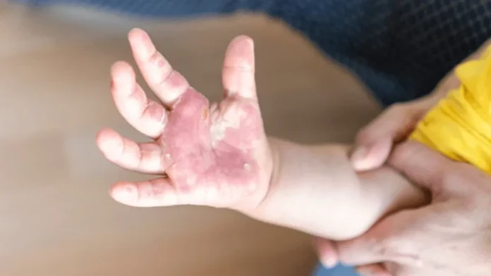 Detienen a hombre por quemarle las manos a sus hijastros menores en Edomex