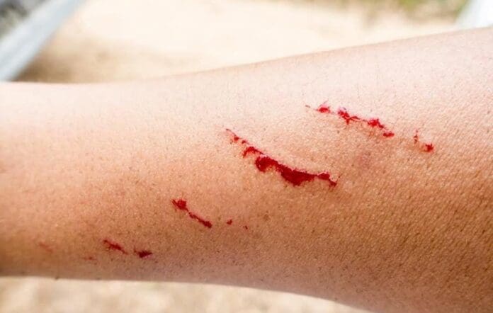 Fallece menor de 17 años por presunto contagio de rabia humana en Zacatecas. Su caso ya se había dado a conocer el 15 de agosto.