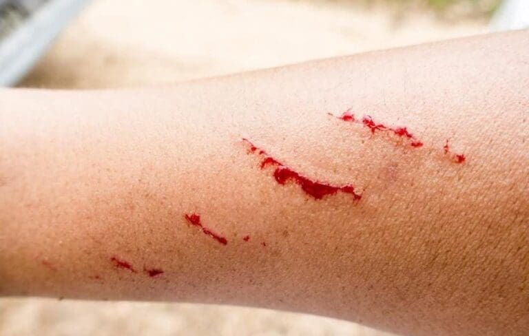 Fallece menor de 17 años por presunto contagio de rabia humana en Zacatecas. Su caso ya se había dado a conocer el 15 de agosto.