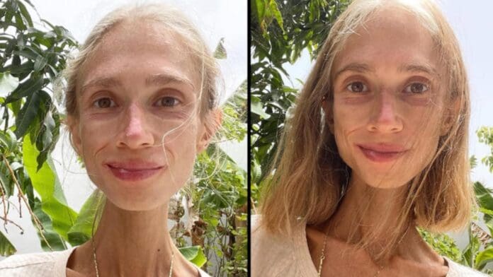 Joven fallece por desnutrición tras seguir dieta vegana de frutas en Bali, Indonesia