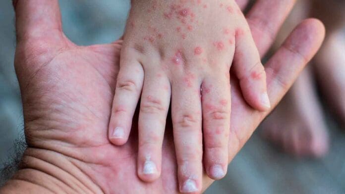 Brote de virus Coxsackie cancela festejos de Día de Muertos en la Sierra de Oaxaca