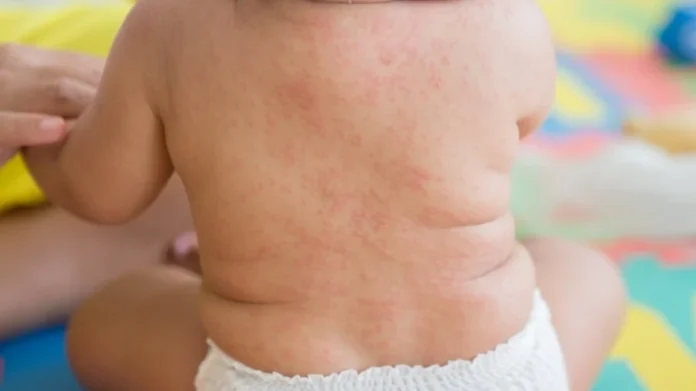 Bebé de un año muere por sarampión en Tlaxcala