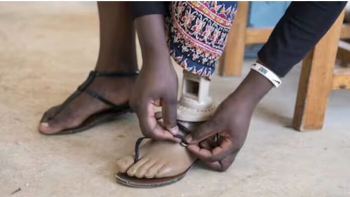 Joven se amputa un pie para ingresar a la facultad de medicina como persona con discapacidad en India