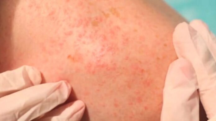 Durango registra la primera muerte por sarampión; un niño de ocho años